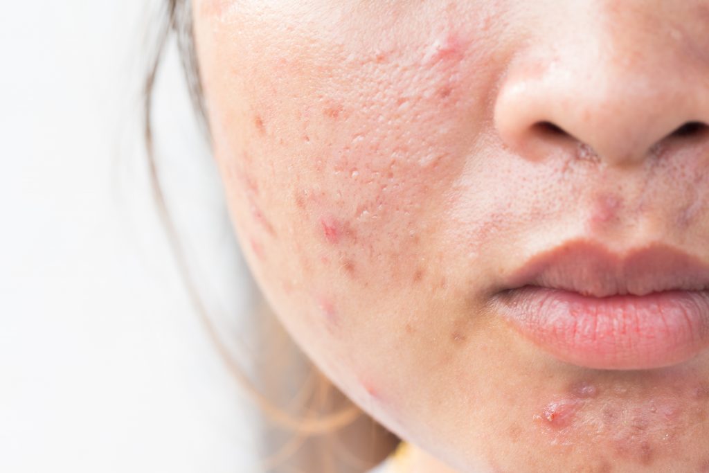 Girl with problematic skin and scars from acne (scar)